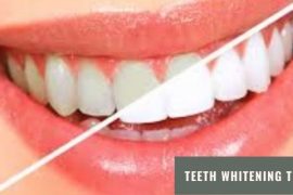 Brief Idea about Teeth Whitening Treatment