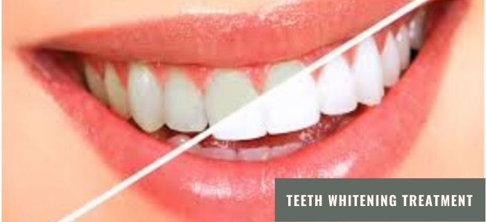 Brief Idea about Teeth Whitening Treatment