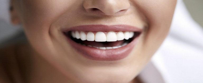 dental veneers