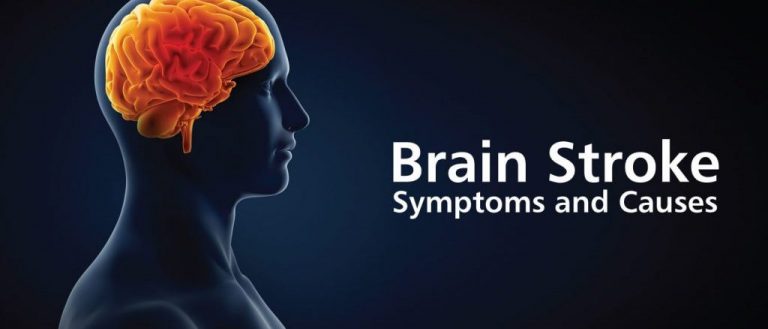 10 Brain Stroke Symptoms that Serve as Indicative Warnings