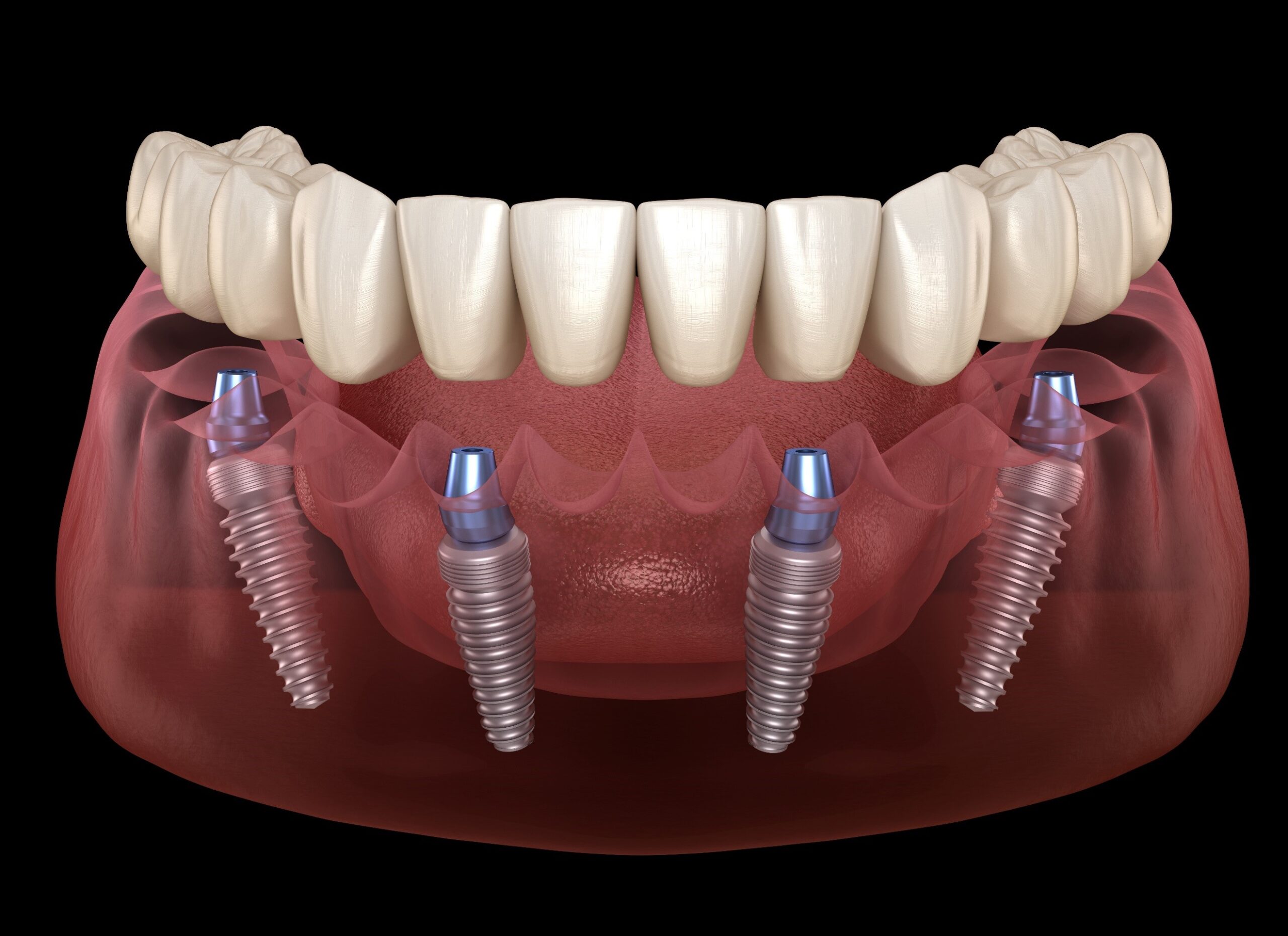 All on 4 Dental Implants