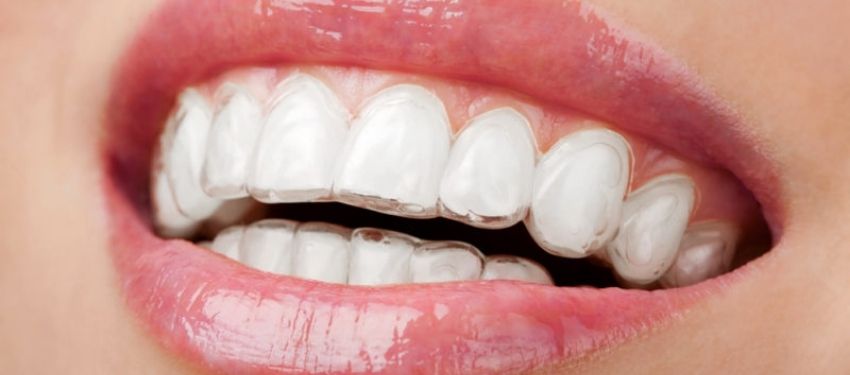 invisalign