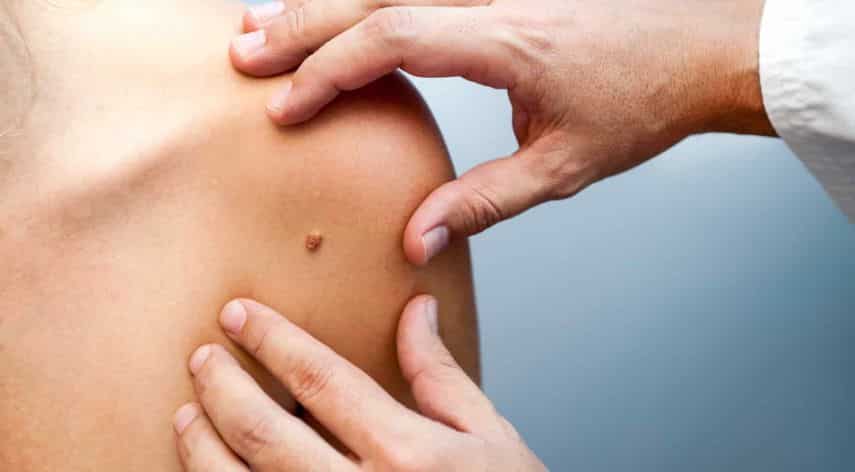 How to Prevent Skin Cancer: The Basics Explained