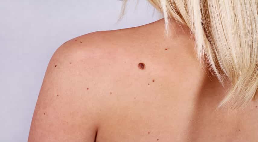 warning signs of skin cancer