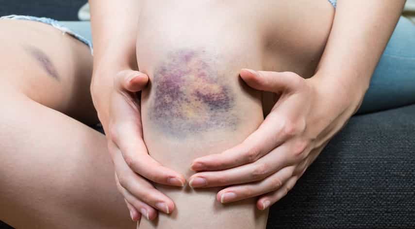 blood clot vs bruise