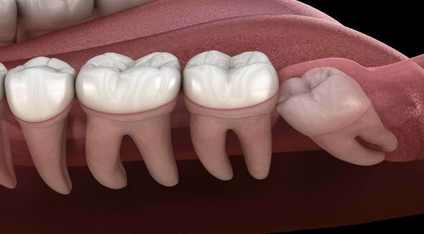 wisdom teeth removal