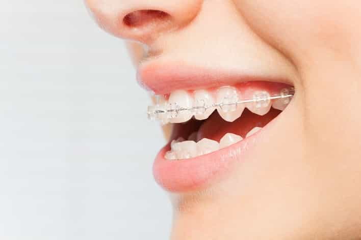straighten teeth
