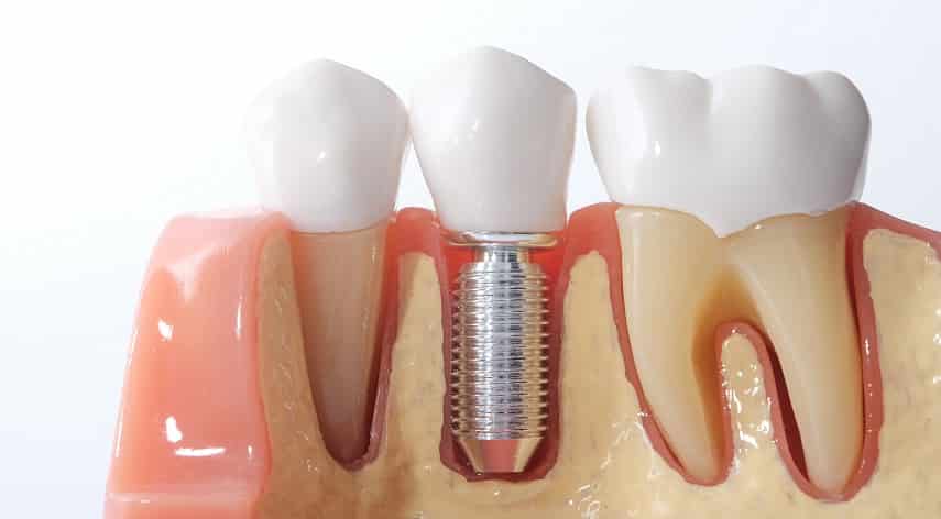missing teeth