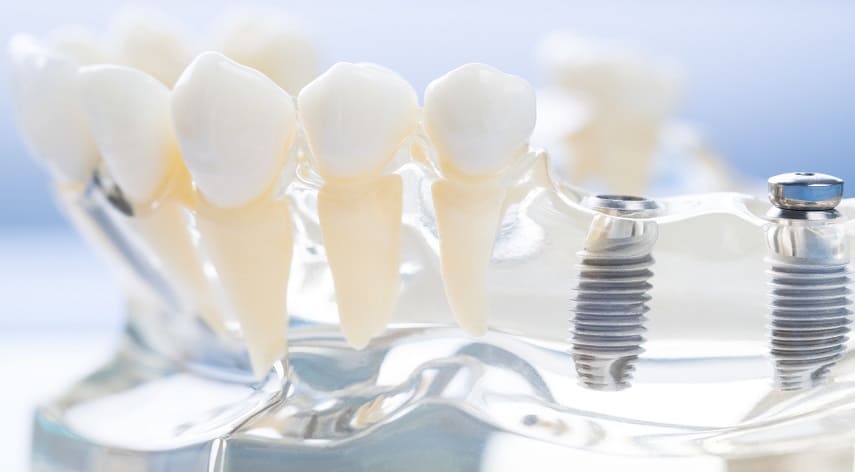 what are dental implants