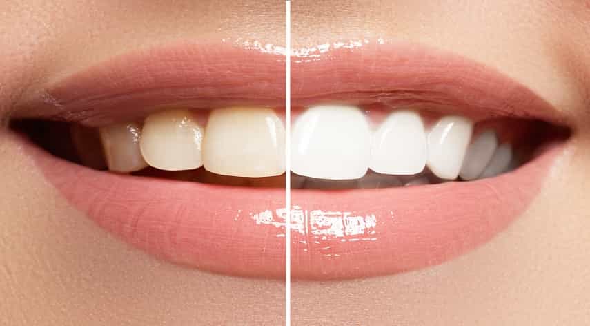 professional teeth whitening near me