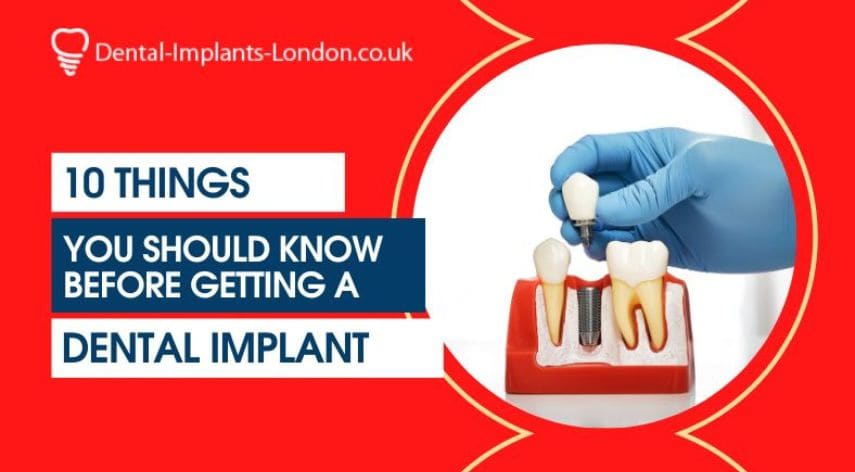 10 Things To Know Before Getting Dental Implants