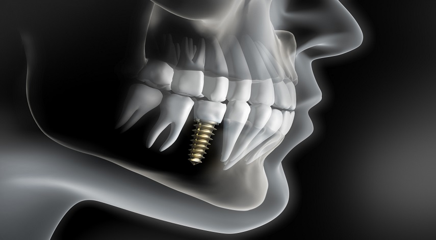 implant replacement