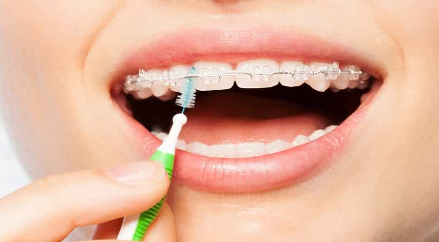 types of orthodontic treatment