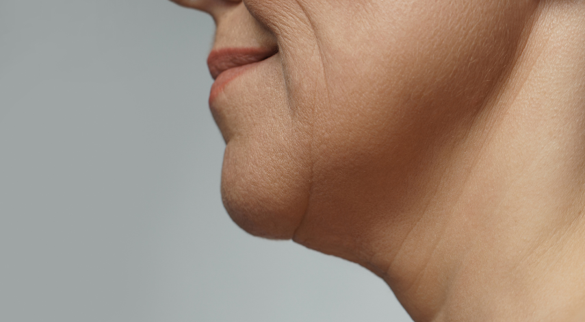 How to Treat Jowls: Top Fixes for Your Sagging Jawline