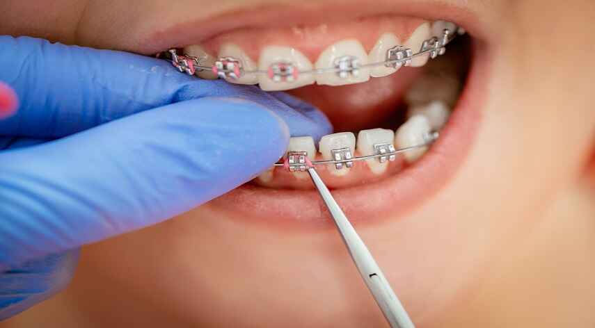 cosmetic braces