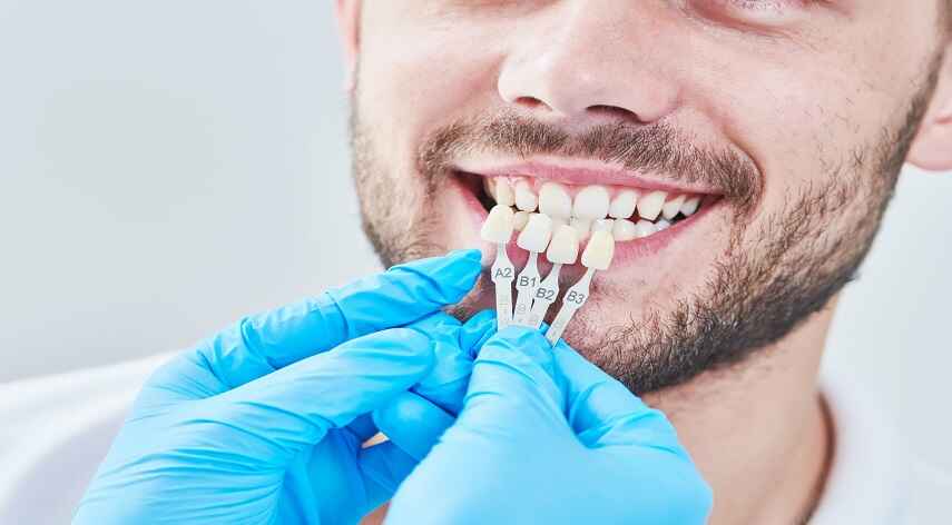 different types of veneers
