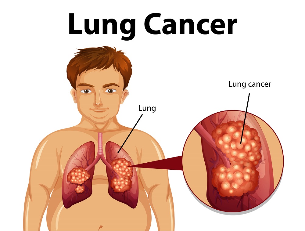 Best Lung Cancer Treatment
